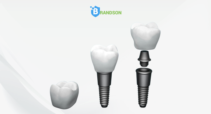 Chọn đúng loại Implant, tỷ lệ thành công cao hơn