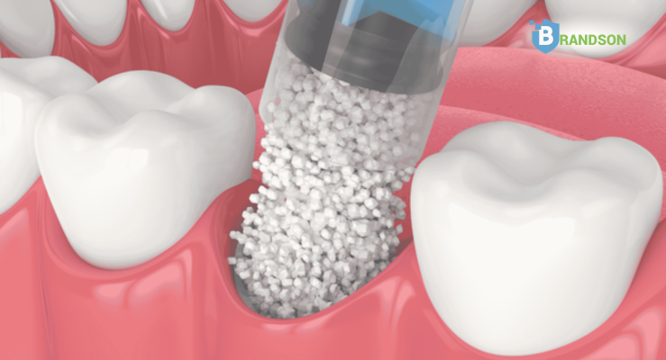 Chọn phương pháp ghép xương