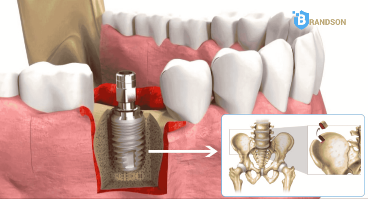 Ghép xương là gì