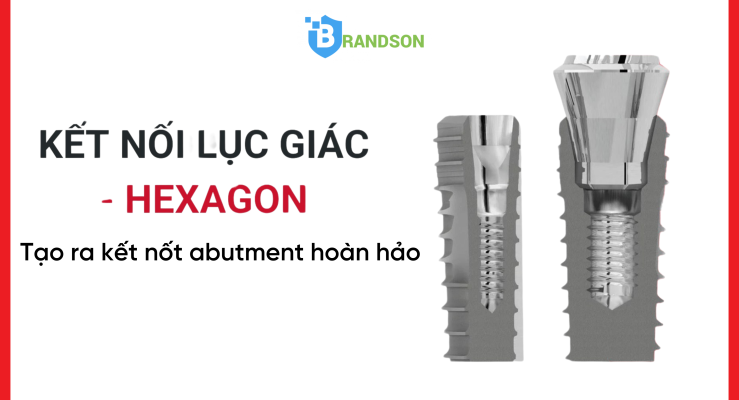 Hệ thống kết nối lục giác tăng cường liên kết giữa implant và trụ răng