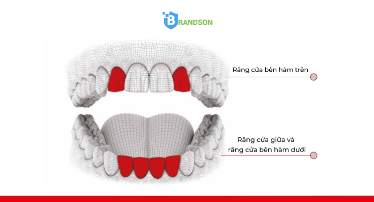 Narrow implant Ø 2.9mm được chỉ định