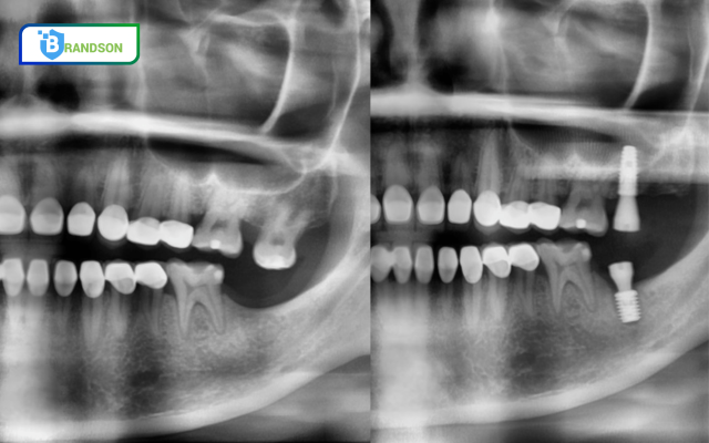 Implantswiss - Giải Pháp Toàn Diện Cho Vị Trí R27 và R37